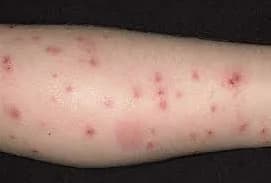 Bed bug bite marks on an arm showing typical clustered pattern