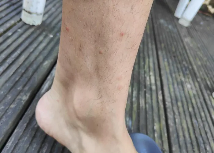 Flea bites on a human lower leg and ankle — typical bite pattern from floor-level fleas