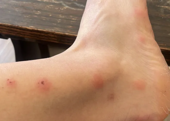 Flea bites on a human foot and ankle showing red, swollen welts