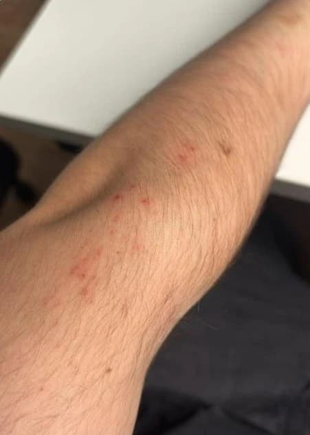 Flea bites on a human arm showing red, irritated welts
