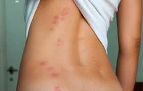 Bed bug bites often appear in lines or clusters on exposed skin. Red, itchy bed bug bites in a cluster pattern on a person's back