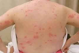 Bed bug bites on the upper body — often the first sign of an infestation. Red bed bug bites covering a person's back — a sign of a severe infestation