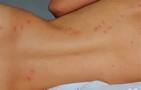 Unexplained bites after travel or hosting guests — investigate immediately. Bed bug bite marks on a person's back showing early signs of infestation